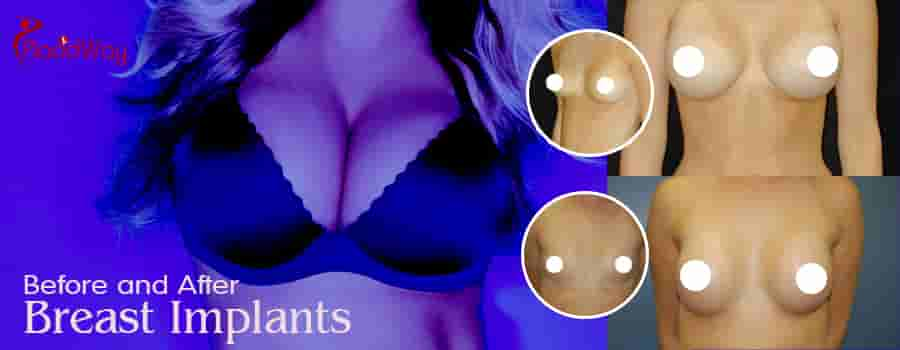 Effective Package for Breast Implants in Antalya Turkey